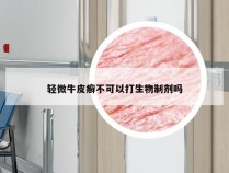 轻微牛皮癣不可以打生物制剂吗