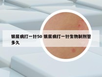银屑病打一针50 银屑病打一针生物制剂管多久