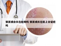 银屑病会长在脸颊吗 银屑病长在脸上会留疤吗