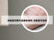 净肤堂对银牛皮癣有用吗 净肤堂可信吗
