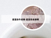 尿蛋白牛皮癣 尿蛋白皮肤痒