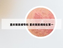 重庆银屑病专科 重庆银屑病排名第一