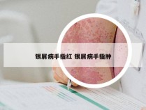 银屑病手指红 银屑病手指肿