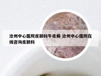 沧州中心医院皮肤科牛皮癣 沧州中心医院在线咨询皮肤科