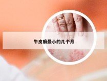 牛皮癣最小的几个月
