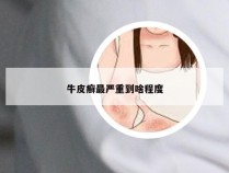 牛皮癣最严重到啥程度