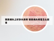银屑病头上好多头屑痒 银屑病头痒是怎么回事