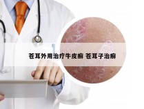苍耳外用治疗牛皮癣 苍耳子治癣