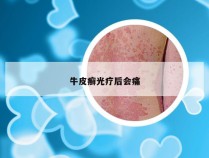牛皮癣光疗后会痛