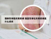 强制性脊髓炎银屑病 强直性脊柱炎银屑病是什么症状