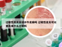 过敏性皮炎会误诊牛皮癣吗 过敏性皮炎可以查出来什么过敏吗