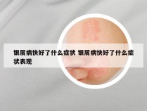 银屑病快好了什么症状 银屑病快好了什么症状表现