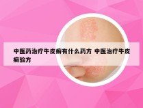 中医药治疗牛皮癣有什么药方 中医治疗牛皮癣验方