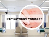 放血疗法治牛皮癣视频 牛皮廨放血治疗