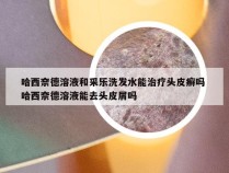 哈西奈德溶液和采乐洗发水能治疗头皮癣吗 哈西奈德溶液能去头皮屑吗