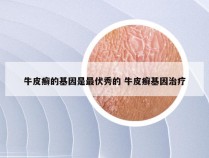 牛皮癣的基因是最伏秀的 牛皮癣基因治疗