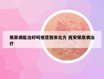 银屑病能治好吗惟壹西安北方 西安银屑病治疗