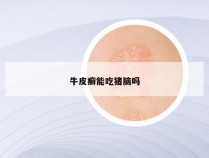 牛皮癣能吃猪脑吗
