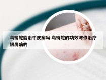 乌梢蛇能治牛皮癣吗 乌梢蛇的功效与作治疗银屑病的