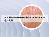 寻常型银屑病要吃多久才能停 寻常性银屑病吃什么药