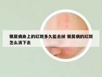 银屑病身上的红斑多久能去掉 银屑病的红斑怎么消下去