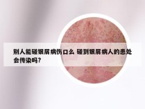 别人能碰银屑病伤口么 碰到银屑病人的患处会传染吗?