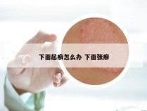 下面起癣怎么办 下面张癣