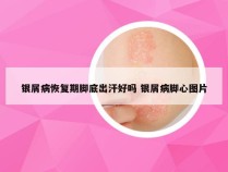 银屑病恢复期脚底出汗好吗 银屑病脚心图片