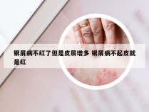 银屑病不红了但是皮屑增多 银屑病不起皮就是红