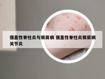强直性脊柱炎与银屑病 强直性脊柱炎银屑病关节炎
