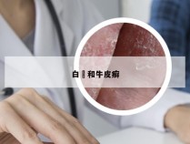 白疕和牛皮癣