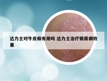 达力士对牛皮癣有用吗 达力士治疗银屑病效果