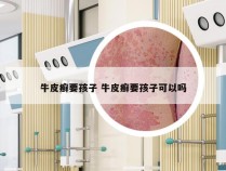 牛皮癣要孩子 牛皮癣要孩子可以吗
