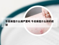 牛皮癣是什么病严重吗 牛皮癣是什么样的症状