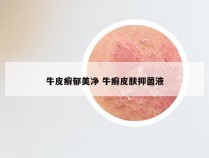 牛皮癣郁美净 牛癣皮肤抑菌液