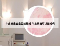 牛皮癣患者是否能结婚 牛皮肤癣可以结婚吗