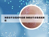 体藓会不会变成牛皮癣 体癣会不会变成皮肤癌