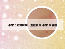手掌上的银屑病一直在脱皮 手掌 银屑病