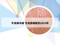 牛皮癣马威 牛皮肤癣新药2019年