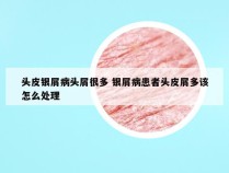 头皮银屑病头屑很多 银屑病患者头皮屑多该怎么处理