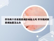 怀孕两个月有银屑病影响胎儿吗 怀孕期间银屑病加重怎么办
