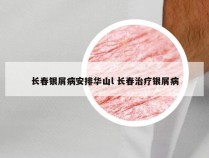 长春银屑病安排华山l 长春治疗银屑病