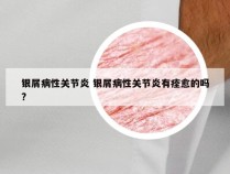 银屑病性关节炎 银屑病性关节炎有痊愈的吗?