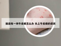 脑袋有一块牛皮癣怎么办 头上牛皮癣的症状
