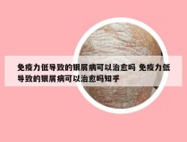免疫力低导致的银屑病可以治愈吗 免疫力低导致的银屑病可以治愈吗知乎