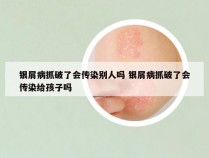 银屑病抓破了会传染别人吗 银屑病抓破了会传染给孩子吗