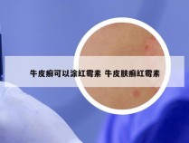 牛皮癣可以涂红霉素 牛皮肤癣红霉素