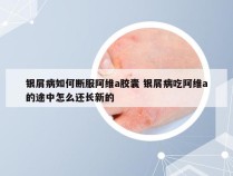 银屑病如何断服阿维a胶囊 银屑病吃阿维a的途中怎么还长新的