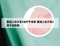 重组人白介素2治疗牛皮癣 重组人白介素2用于皮肤病