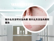 有什么方法可以治头癣 用什么方法治头癣效果快